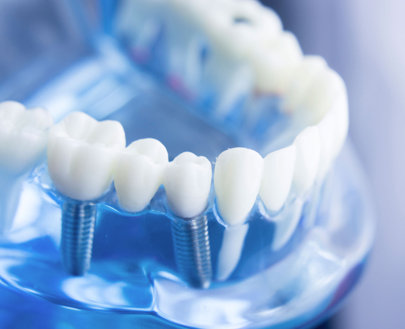 Dental Implants