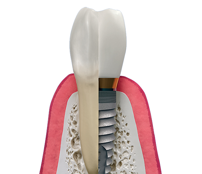 How Implants Work